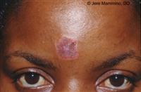 Discoid Lupus Erythematosus Treatment in NYC