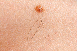 Early Detection of Melanoma