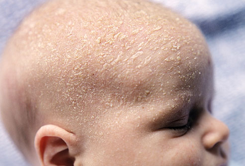 newborn dry skin