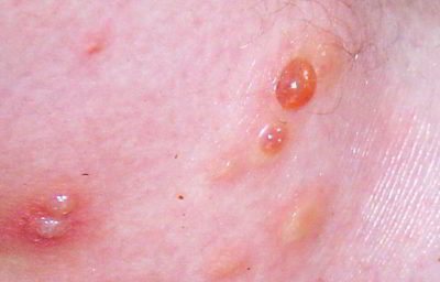 Mosquito Bite Treatment in NYC