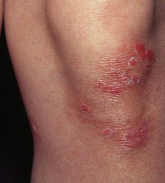 Psoriasis Treatment in NYC