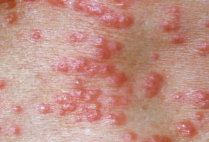 Scabies Treatment in NYC